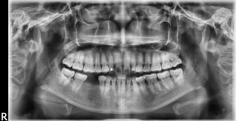 Finding a Panoramic X-Ray Near You: A Complete Guide to Dental Imaging
